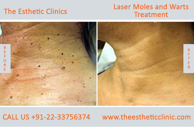 Moles Wart Skin Tags Laser Treatment before after photos in mumbai india (2)